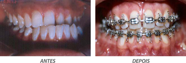 Buco-Maxilo-Facial Curitiba Clareamento Dental Curitiba