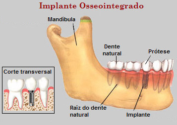 Implante Curitiba