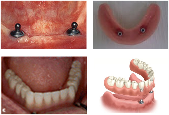 Overdenture Curitiba